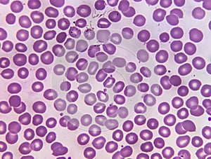 Acute thrombocytopenia and leucocytopenia. photo