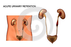 Acute urinary retention