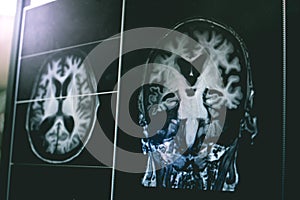 AD with CVD white matter change