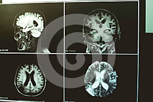 AD with CVD white matter change