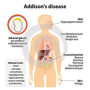 Addison's disease