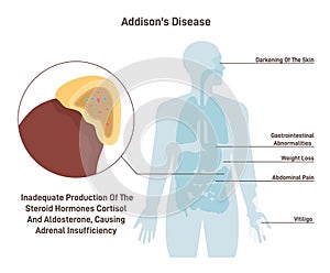 Addison's disease. Symptoms of chronic adrenal insufficiency or hypocortisolism