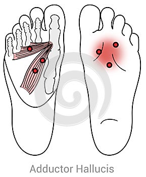 Adductor hallucis myofascial trigger points may cause pain in the metatarsals .