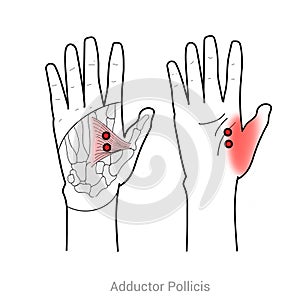 Adductor pollicis: Trigger point thumb pain