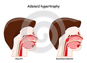 Adenoid hypertrophy