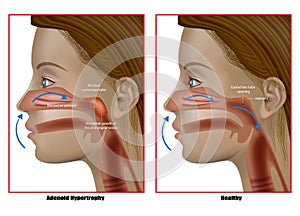 Adenoid hypertrophy, the abnormal growth of the pharyngeal tonsils. Adenoidectomy. Eustachian Tube Dysfunction photo