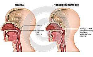 Adenoid hypertrophy medical  illustration on white background