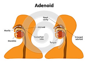 Adenoid. Normal and Enlarged adenoid