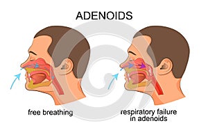 Adenoiditis, respiratory failure