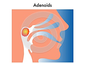 Adenoids