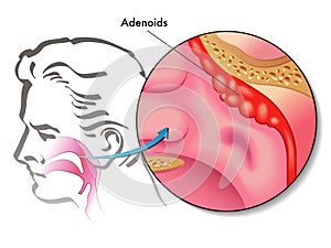 Adenoids photo