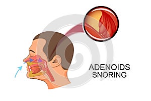 Adenoids cause snoring photo