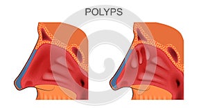 Adenoids in nose