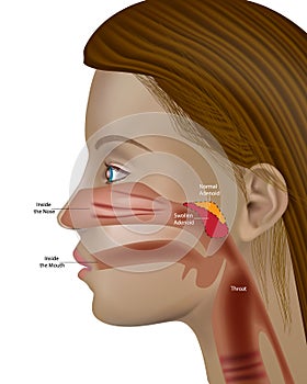 Adenoids, pharyngeal tonsil or nasopharyngeal tonsil Otolaryngology Adenoid hypertrophy photo