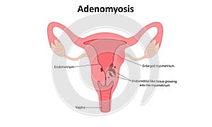 Adenomyosis vector illustration