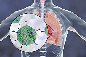 Adenovirus infection, adenoviruses in human lungs photo