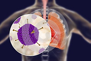 Adenovirus infection, adenoviruses in human lungs photo