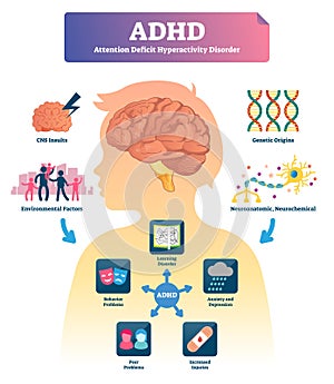 ADHD vector illustration. Labeled mind attention deficit disorder scheme. photo
