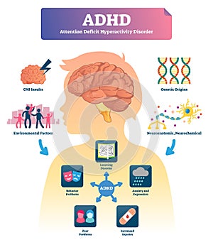 ADHD vector illustration. Labeled mind attention deficit disorder scheme.