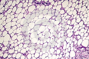 Pericarditis, light micrograph, photo under microscope photo