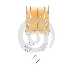 Adjacent tissue transfer or rearrangement, trunk defect 10 sq cm or less