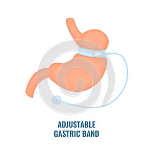 Adjustable gastric band bariatric surgery weight loss infographics