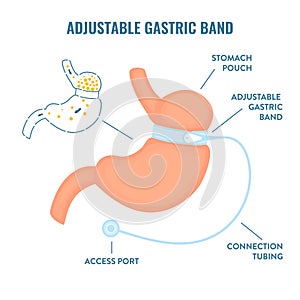 Adjustable gastric band bariatric surgery weight loss infographics