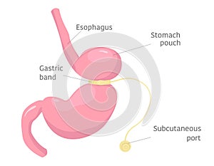 Adjustable gastric band on stomach. Human anatomy illustration for infographics, atlas, textbook or study material.