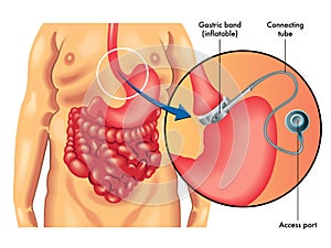 Adjustable Gastric Banding