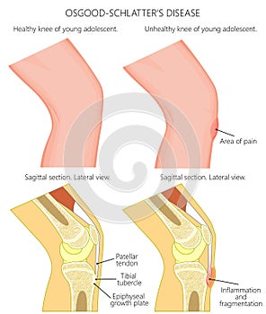 Adolescent knee pain_Osgood Schlatter disease