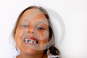 Adorable girl with open toothless mouth with temporary milk crowding teeth in white studio. Dental work with cross bite