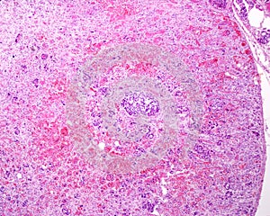 Adrenal cortex carcinoma