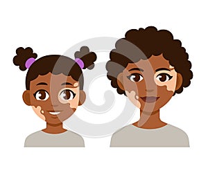 Adult and child with vitiligo photo