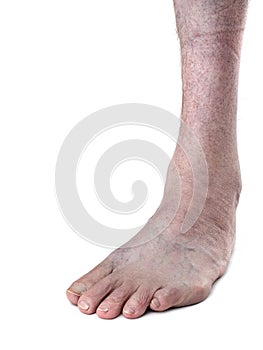Adult male with club foot aka talipes, despite childhood intervention. On white.