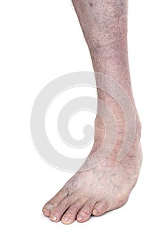 Adult male with club foot aka talipes, despite childhood intervention. On white.