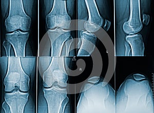 Adult male knees x-ray image. Medical and human anatomy imagery