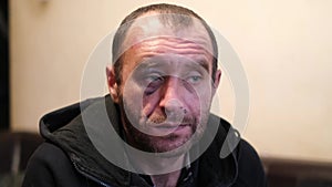 An adult man with a bruise under his eye. The problem of alcohol dependence.