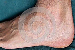 Adult mans foot with varicose veins