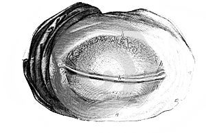Adult palpebral conjunctiva in the old book D`Anatomie Chirurgicale, by B. Anger, 1869, Paris photo
