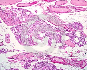 Adult parathyroid gland photo
