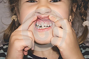 Adult permanent teeth coming in front of the child`s baby teeth: shark teeth