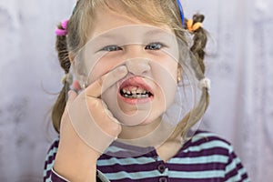 Adult permanent teeth coming in front of the child`s baby teeth: shark teeth