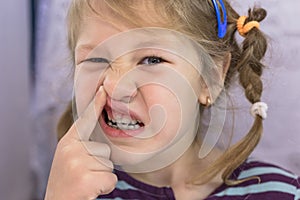 Adult permanent teeth coming in front of the child`s baby teeth: shark teeth