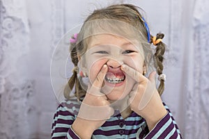 Adult permanent teeth coming in front of the child`s baby teeth: shark teeth