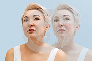 Adult pretty woman, showing results before and after beauty treatment. Double exposure. Concept of couperose and