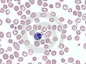 Adult T-cell leukemia lymphoma. photo