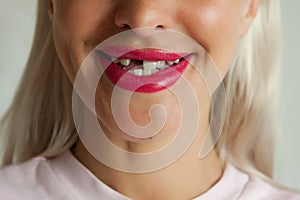 Adult woman with broken front tooth smiling