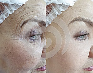 Adult woman wrinkles removal skin collagen therapy hydrating effect regeneration treatment before and after treatment