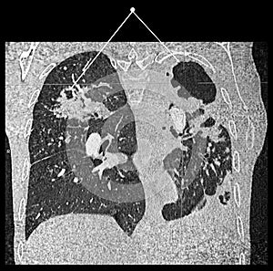 Advanced Lung tuberculosis. CT-scan reconstruction.