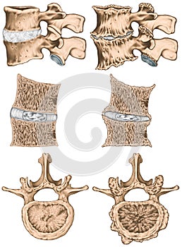 Advanced uncovertebral arthrosis